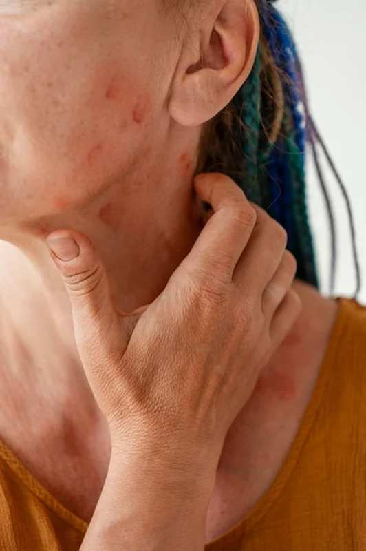 Osoba cierpiąca na zapalenie skóry bez łojotokowego